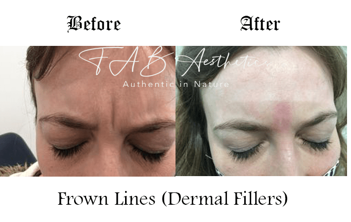 Fab Clinic Facial Injections Frown Line Wrinkles Dermal Filler